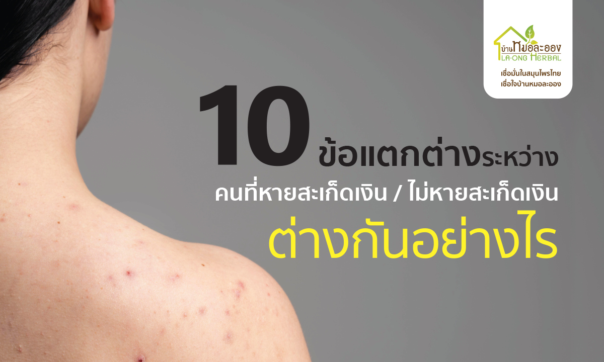 Images/Blog/gZukTsxp-03_May22_01 FB ข้อแตกต่าง ระหว่างคนที่หายสะเก็ดเงิ.png